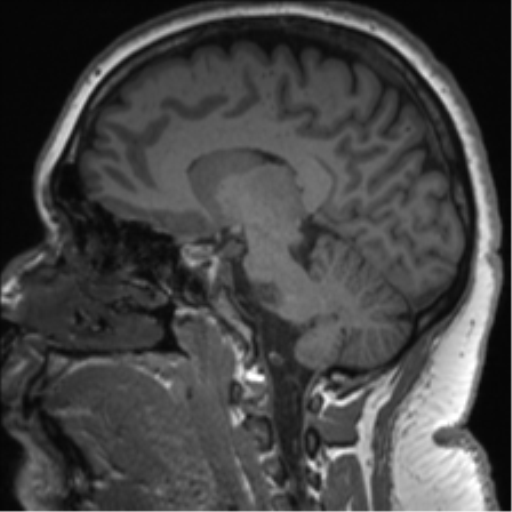 File:Cerebellopontine angle meningioma (Radiopaedia 48434-53348 Sagittal T1 42).png