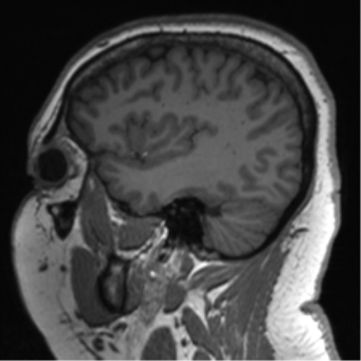 Cerebellopontine angle meningioma (Radiopaedia 48434-53348 Sagittal T1 67).png