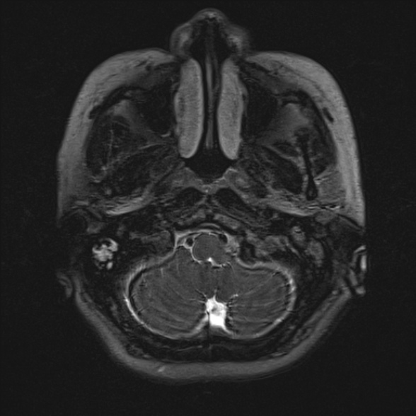 Cerebellopontine angle meningioma (Radiopaedia 53561-59591 Axial 3D volume T2 20).jpg