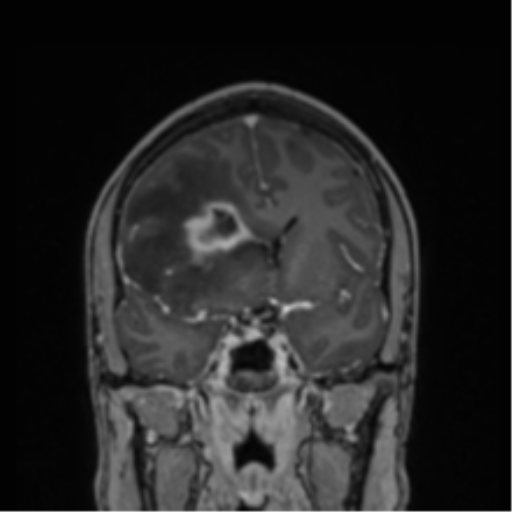 File:Cerebral abscess (Radiopaedia 60342-68009 H 31).png