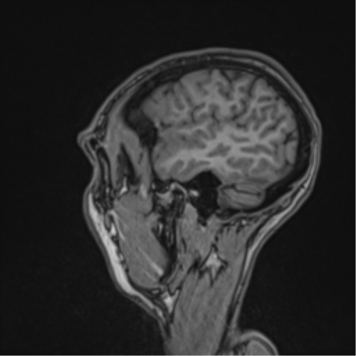 Cerebral abscess (Radiopaedia 60342-68009 Sagittal T1 13).png