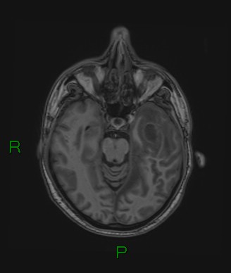 Cerebral abscess and subdural empyema (Radiopaedia 84436-99779 Axial T1 55).jpg
