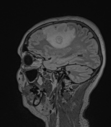 Cerebral abscess from pulmonary arteriovenous malformation (Radiopaedia 86275-102291 Sagittal FLAIR 51).png