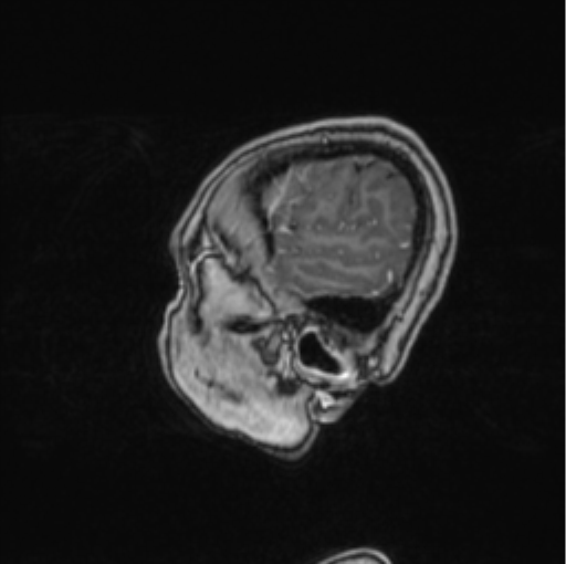 Cerebral abscess from pulmonary arteriovenous malformation (Radiopaedia 86275-102291 Sagittal T1 C+ 69).png