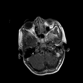 File:Cerebral abscess post cardiac surgery (Radiopaedia 27244-27420 Axial T1 C+ 2).jpg