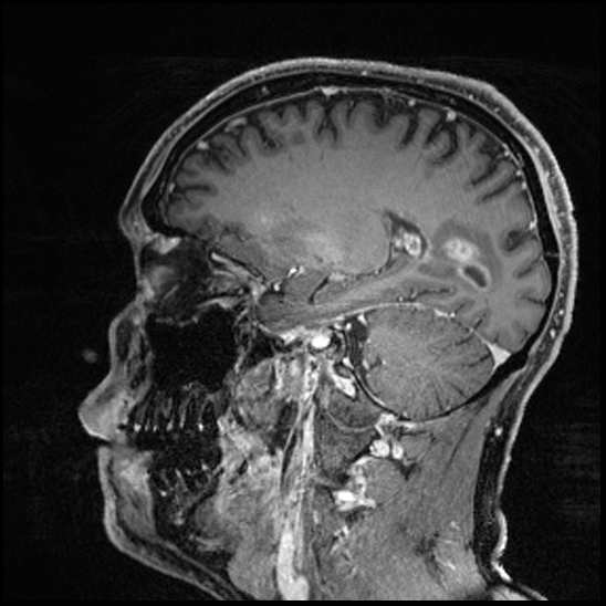 Cerebral abscess with ventriculitis (Radiopaedia 78965-91878 Sagittal T1 C+ 68).jpg