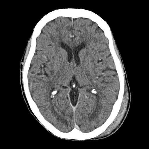 Cerebral amyloid angiopathy-related inflammation (Radiopaedia 74836-85848 Axial non-contrast 33).jpg
