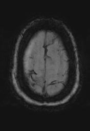 File:Cerebral amyloid angiopathy (Radiopaedia 29129-29518 Axial SWI MPR 33).jpg