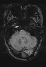 File:Cerebral amyloid angiopathy (Radiopaedia 29129-29518 Axial SWI MPR 7).jpg