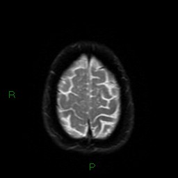 Cerebral amyloid angiopathy (Radiopaedia 77506-89664 Axial DWI 53).jpg