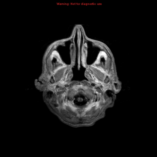 File:Cerebral and orbital tuberculomas (Radiopaedia 13308-13311 Axial T1 C+ 1).jpg