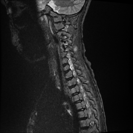 File:Cerebral and spinal tuberculosis (Radiopaedia 90489-107838 Sagittal STIR 3).jpg