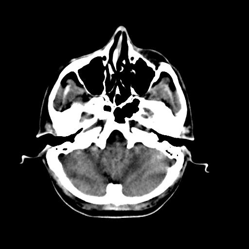 Cerebral arteriovenous malformation (Radiopaedia 28518-28759 Axial non-contrast 13).jpg
