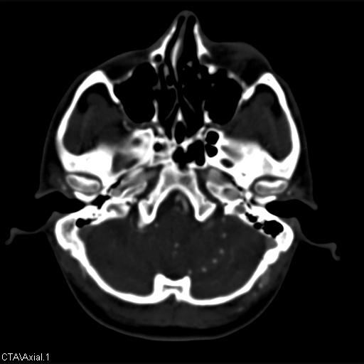 Cerebral arteriovenous malformation (Radiopaedia 28518-28759 B 1).jpg