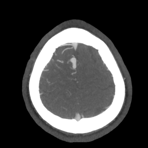 Cerebral arteriovenous malformation (Radiopaedia 39259-41505 AX CEREBRAL CTA 50).png