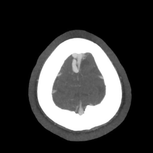 Cerebral arteriovenous malformation (Radiopaedia 39259-41505 AX CEREBRAL CTA 54).png