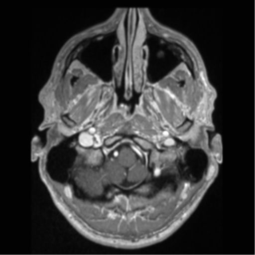 Cerebral arteriovenous malformation (Radiopaedia 55798-62372 Axial T1 C+ 7).png