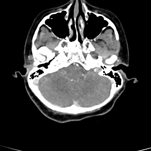 Cerebral arteriovenous malformation (Radiopaedia 73830-84645 B 80).jpg