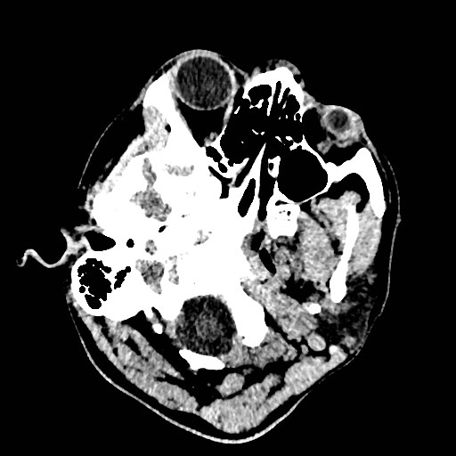 Cerebral arteriovenous malformation (Radiopaedia 79677-92887 Axial non-contrast 2).jpg