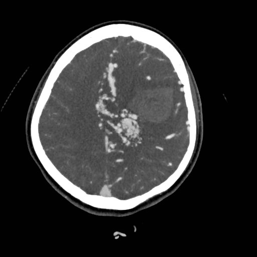 File:Cerebral arteriovenous malformation (Radiopaedia 79677-92888 A 41).jpg