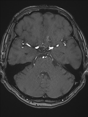 Cerebral arteriovenous malformation (Radiopaedia 84015-99245 Axial TOF 92).jpg