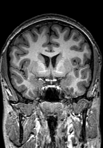 Cerebral arteriovenous malformation at posterior body of corpus callosum (Radiopaedia 74111-84925 Coronal T1 133).jpg