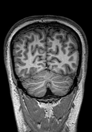 Cerebral arteriovenous malformation at posterior body of corpus callosum (Radiopaedia 74111-84925 Coronal T1 290).jpg