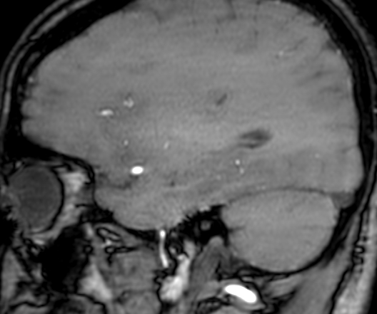 Cerebral arteriovenous malformation at posterior body of corpus callosum (Radiopaedia 74111-84925 J 290).jpg