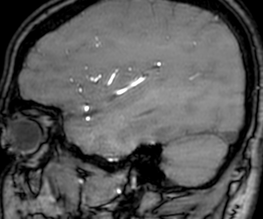 Cerebral arteriovenous malformation at posterior body of corpus callosum (Radiopaedia 74111-84925 J 311).jpg