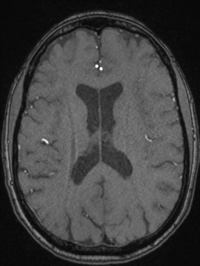 Cerebral arteriovenous malformation with hemorrhage (Radiopaedia 34422-35737 Axial MRA 50).png