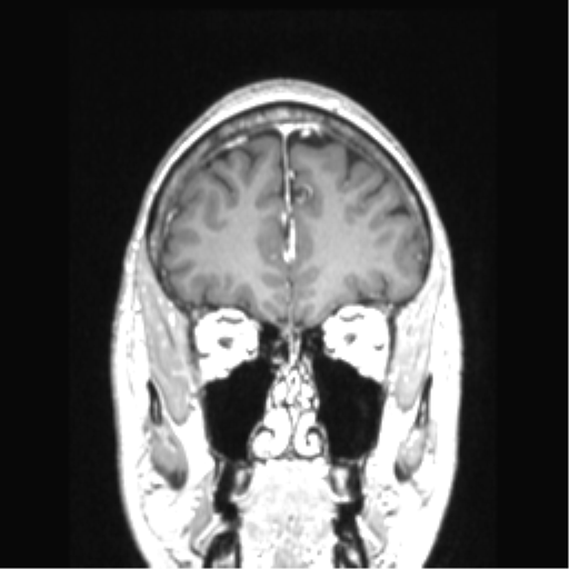 Cerebral arteriovenous malformation with hemorrhage (Radiopaedia 34422-35737 Coronal T1 C+ 73).png