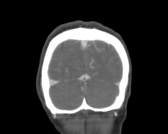 File:Cerebral arteriovenous malformation with lobar hemorrhage (Radiopaedia 44725-48511 A 51).png