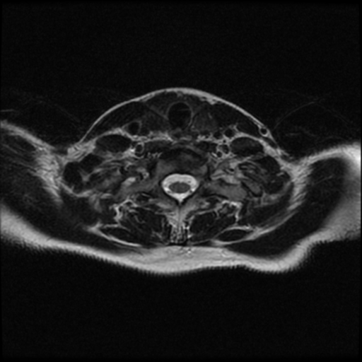 File:Cerebral autosomal dominant arteriopathy with subcortical infarcts and leukoencephalopathy (CADASIL) (Radiopaedia 41018-43763 Ax T2 C2-T1 25).png