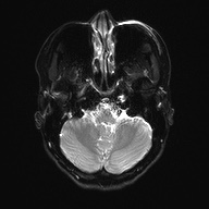 Cerebral cavernous venous malformation (Radiopaedia 70008-80021 Axial DWI 6).jpg