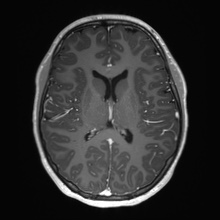 Cerebral cavernous venous malformation (Radiopaedia 70008-80021 Axial T1 C+ 42).jpg
