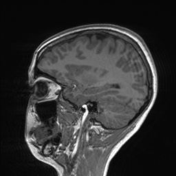 File:Cerebral cavernous venous malformation (Radiopaedia 70008-80021 Sagittal T1 23).jpg