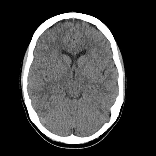Cerebral cavernous venous malformation (Radiopaedia 70008-80022 Axial non-contrast 21).jpg