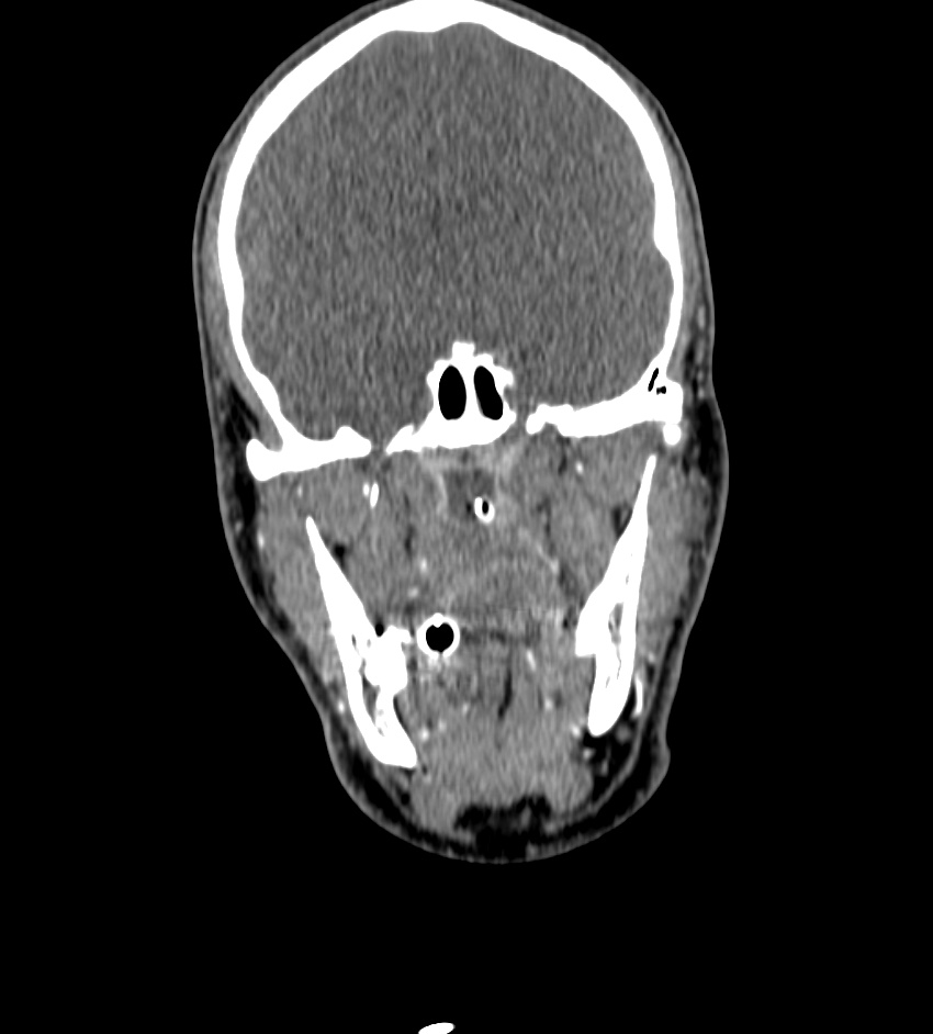 Cerebral edema in an overdose patient (Radiopaedia 72005-82539 B 24).jpg