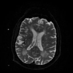Cerebral embolic infarcts (embolic shower) (Radiopaedia 49837-55108 Axial DWI 19).jpg