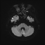 File:Cerebral embolic infarcts (embolic shower) (Radiopaedia 72391-82921 Axial DWI 37).jpg