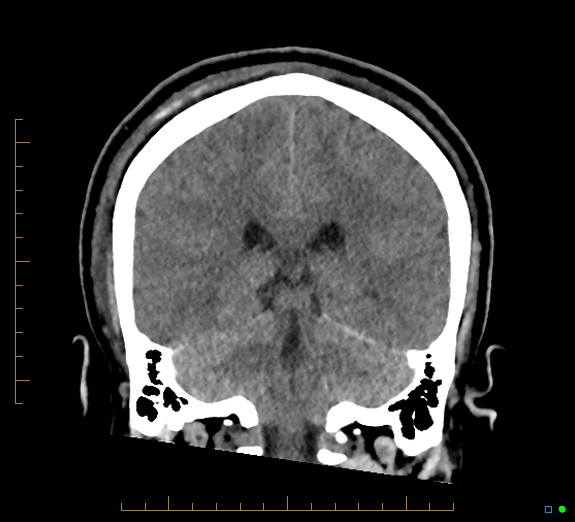 Cerebral fat embolism (Radiopaedia 85521-101224 Coronal non-contrast 41).jpg