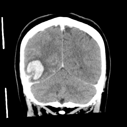 Cerebral hemorrhage secondary to arteriovenous malformation (Radiopaedia 33497-34561 C 50).png