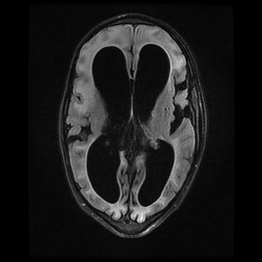 File:Cerebral manifestations of mucopolysaccharidosis type I (Radiopaedia 59171-66487 Axial FLAIR 11).jpg