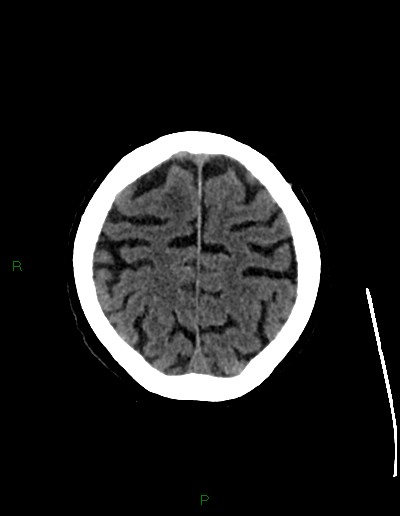 Cerebral metastases - ependymal and parenchymal (Radiopaedia 79877-93131 Axial non-contrast 65).jpg