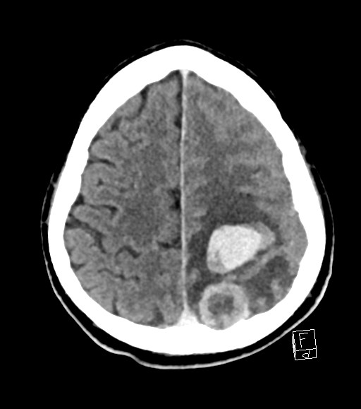 Cerebral metastases - testicular choriocarcinoma (Radiopaedia 84486-99855 Axial C+ delayed 16).jpg