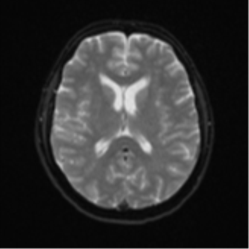 File:Cerebral metastases mimicking abscesses (Radiopaedia 45841-50131 Axial DWI 17).png
