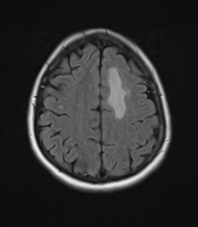 File:Cerebral metastases mimicking abscesses (Radiopaedia 45841-50131 Axial FLAIR 22).png