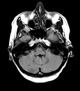 File:Cerebral metastasis (Radiopaedia 46744-51248 Axial FLAIR 6).png