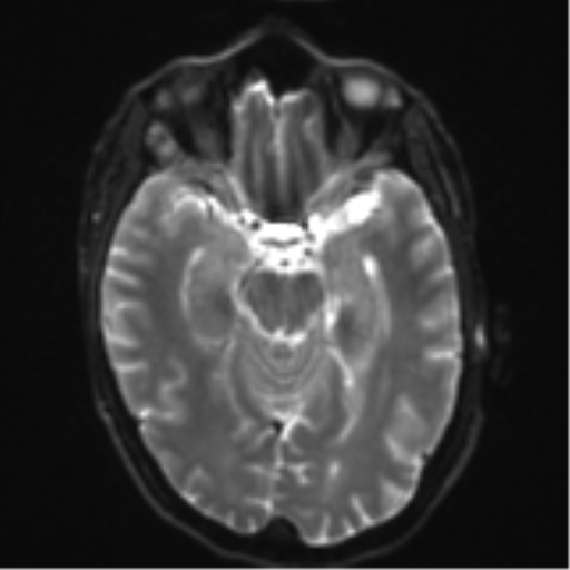 File:Cerebral metastasis - melanoma (Radiopaedia 54718-60954 Axial DWI 12).png