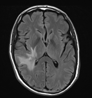 File:Cerebral metastasis - melanoma (Radiopaedia 54718-60954 Axial FLAIR 16).png